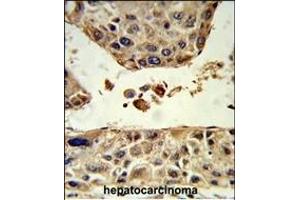Formalin-fixed and paraffin-embedded human hepatocarcinoma reacted with HPD Antibody (C-term), which was peroxidase-conjugated to the secondary antibody, followed by DAB staining.