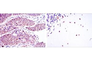 Immunohistochemical analysis of paraffin-embedded ovarian cancer (left) and cerebellum tissues (right) using MSI2 mouse mAb with DAB staining. (MSI2 Antikörper)