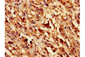Immunohistochemistry of paraffin-embedded human melanoma using ABIN7153440 at dilution of 1:100 (LGALS1/Galectin 1 Antikörper  (AA 2-135))