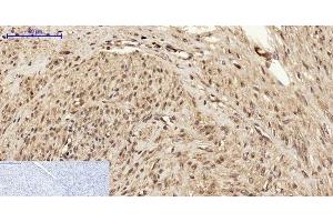 Immunohistochemistry of paraffin-embedded Human uterus cancer tissue using BRCA1 Polyclonal Antibody at dilution of 1:200. (BRCA1 Antikörper)