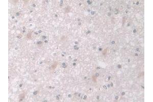 Detection of MAPK12 in Human Glioma Tissue using Polyclonal Antibody to Mitogen Activated Protein Kinase 12 (MAPK12)