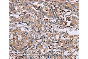 Immunohistochemistry of Human liver cancer using MAGEA3 Polyclonal Antibody at dilution of 1:50 (MAGEA3 Antikörper)