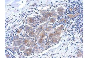 IHC-P Image Immunohistochemical analysis of paraffin-embedded human breast cancer, using SERPINB6 antibody, antibody at 1:500 dilution. (SERPINB6 Antikörper  (Internal Region))