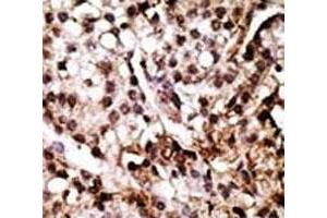 IHC analysis of FFPE human breast carcinoma tissue stained with the ATG7 antibody