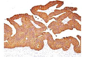 Formalin-fixed, paraffin-embedded human Colon Carcinoma stained with EpCAM Mouse Monoclonal Antibody (EGP40/837). (EpCAM Antikörper)