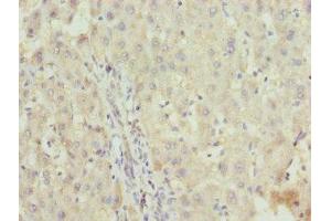 Immunohistochemistry of paraffin-embedded human liver cancer using ABIN7176188 at dilution of 1:100 (ZNF253 Antikörper  (AA 80-300))