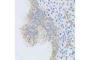 Immunohistochemistry of paraffin-embedded human uterine cancer using ABCC1 Antibody. (ABCC1 Antikörper)