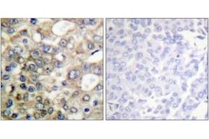 Immunohistochemistry analysis of paraffin-embedded human breast carcinoma, using CD227/MUC1 (Phospho-Tyr1229) Antibody. (MUC1 Antikörper  (pTyr1229))