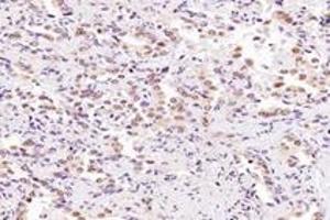 Immunohistochemistry analysis of paraffin-embedded human lung cancer using SRFBP1 (ABIN7075579) at dilution of 1: 2000 (SRFBP1 Antikörper)
