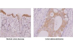 Paraffin embedded sections of normal colon mucosa and colon adenocalcinoma tissue were incubated with anti-human IRF-5 antibody (1:50) for 2 hours at room temperature. (IRF5 Antikörper)