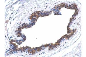 IHC-P Image Immunohistochemical analysis of paraffin-embedded human breast cancer, using MAPK4, antibody at 1:500 dilution. (MAPK4 Antikörper)