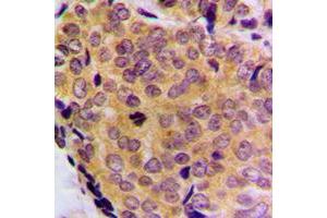 Immunohistochemical analysis of BCLW staining in human breast cancer formalin fixed paraffin embedded tissue section.