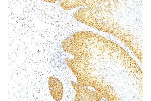 Formalin-fixed, paraffin-embedded human Cervical Carcinoma stained with p27 Mouse Monoclonal Antibody (KIP1/769). (CDKN1B Antikörper)