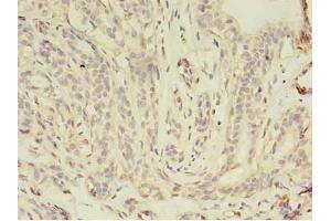 Immunohistochemistry of paraffin-embedded human breast cancer using ABIN7157158 at dilution of 1:100 (JUP Antikörper  (AA 1-131))