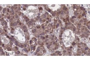 ABIN6273912 at 1/100 staining Human liver cancer tissue by IHC-P.