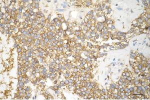 Immunohistochemistry was performed on paraffin-embedded human breast carcinoma using phospho-eIF4B (S406) antibody (ABIN7798527), 1:200).