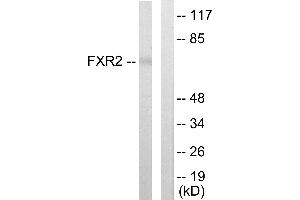 Immunohistochemistry analysis of paraffin-embedded human lung carcinoma tissue using FXR2 antibody. (FXR2 Antikörper  (Internal Region))