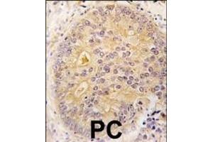 Formalin-fixed and paraffin-embedded human prostata carcinoma tissue reacted with CKK2 antibody (N-term) (ABIN391182 and ABIN2841279) , which was peroxidase-conjugated to the secondary antibody, followed by DAB staining. (CAMKK2 Antikörper  (N-Term))