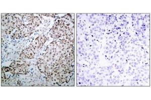 Immunohistochemical analysis of paraffin-embedded human breast carcinoma tissue using p53(Phospho-Ser315) Antibody(left) or the same antibody preincubated with blocking peptide(right). (p53 Antikörper  (pSer315))