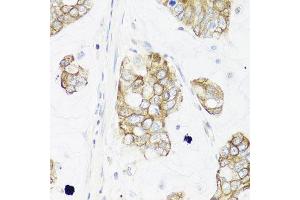 Immunohistochemistry of paraffin-embedded human gastric cancer using IER3 antibody at dilution of 1:100 (x40 lens). (IER3 Antikörper)