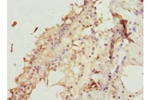Immunohistochemistry of paraffin-embedded human breast cancer using ABIN7176187 at dilution of 1:100 (ZNF24 Antikörper  (AA 169-368))