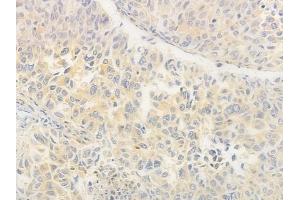 ABIN6264552 and ABIN6276570 at 1/100 staining human lung squamous cell carcinoma by IHC-P. (RAB11A Antikörper  (C-Term))