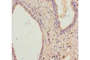 Immunohistochemistry of paraffin-embedded human prostate cancer using ABIN7167832 at dilution of 1:100 (RDH11 Antikörper  (AA 22-318))