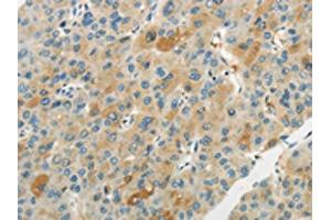 The image on the left is immunohistochemistry of paraffin-embedded Human liver cancer tissue using ABIN7193065(WNT2B Antibody) at dilution 1/20, on the right is treated with synthetic peptide. (WNT2B Antikörper)