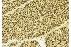 ABIN6268873 at 1/100 staining Human breast cancer tissue by IHC-P. (DREAM Antikörper  (Internal Region))