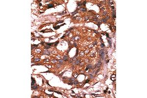 Formalin-fixed and paraffin-embedded human cancer tissue reacted with the primary antibody, which was peroxidase-conjugated to the secondary antibody, followed by AEC staining. (GUCY1A1 Antikörper  (N-Term))
