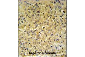 INSC Antibody IHC analysis in formalin fixed and paraffin embedded hepatocarcinoma followed by peroxidase conjugation of the secondary antibody and DAB staining. (INSC Antikörper  (AA 410-437))