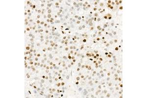 Immunohistochemistry of paraffin-embedded human liver cancer using Phospho-POLR2A CTD-S5 Rabbit mAb  at dilution of 1:200 (40x lens).