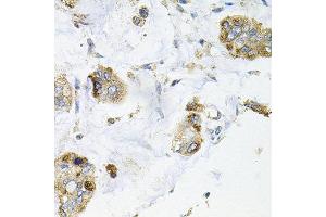 Immunohistochemistry of paraffin-embedded human gastric cancer using GALC antibody at dilution of 1:100 (x40 lens). (GALC Antikörper)