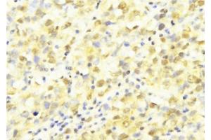 ABIN6277569 at 1/100 staining Human breast cancer tissue by IHC-P. (HUS1 Antikörper  (Internal Region))