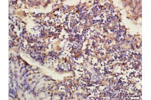 Formalin-fixed and paraffin embedded human laryngo carcinoma labeled with Rabbit Anti-DNAJB12 Polyclonal Antibody, Unconjugated (ABIN2173711) at 1:200 followed by conjugation to the secondary antibody and DAB staining (DNAJB12 Antikörper  (AA 26-130))