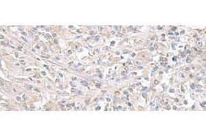 Immunohistochemistry of paraffin-embedded Human liver cancer tissue using FXYD6 Polyclonal Antibody at dilution of 1:65(x200)