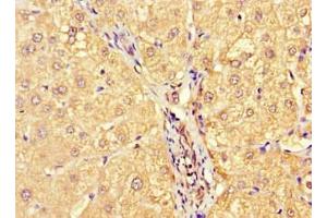 Immunohistochemistry of paraffin-embedded human liver cancer using ABIN7143724 at dilution of 1:100 (Allergin-1 Antikörper  (AA 249-343))