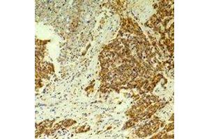 Immunohistochemical analysis of CLIC4 staining in human breast cancer,rat brain formalin fixed paraffin embedded tissue section. (CLIC4 Antikörper)