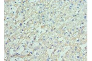 Immunohistochemistry of paraffin-embedded human liver cancer using ABIN7151389 at dilution of 1:100 (ENPP2 Antikörper  (AA 564-863))