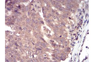 Immunohistochemical analysis of paraffin-embedded ovarian cancer tissues using SLINGSHOT-1L mouse mAb with DAB staining. (SSH1 Antikörper  (AA 1032-1044))
