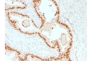 Formalin-fixed, paraffin-embedded human Prostate Carcinoma stained with FOXA1 Mouse Recombinant Monoclonal Antibody (rFOXA1/1515). (Rekombinanter FOXA1 Antikörper  (AA 372-472))