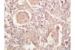 Formalin-fixed and paraffin embedded human lung carcinoma labeled with Rabbit Anti-MHC Class II Polyclonal Antibody, Unconjugated  at 1:200 followed by conjugation to the secondary antibody and DAB staining (MHC Class II Antikörper  (AA 111-200))