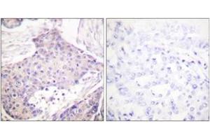 Immunohistochemistry analysis of paraffin-embedded human breast carcinoma tissue, using CARD6 Antibody. (CARD6 Antikörper  (AA 1-50))