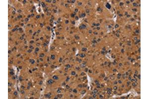 The image on the left is immunohistochemistry of paraffin-embedded Human liver cancer tissue using ABIN7191712(NRAS Antibody) at dilution 1/40, on the right is treated with synthetic peptide. (GTPase NRas Antikörper)