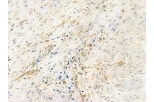 ABIN6257817 and ABIN6274533 at 1/100 staining human prostate carcinoma by IHC-P.