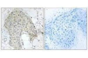 Immunohistochemistry analysis of paraffin-embedded human breast carcinoma tissue using PPP1R2 (Ab-120/121) antibody. (PPP1R2 Antikörper  (Ser120, Ser121))