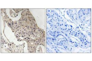 Immunohistochemistry analysis of paraffin-embedded human breast carcinoma tissue, using Gab2 (Phospho-Ser623) antibody. (GAB2 Antikörper  (pSer623))