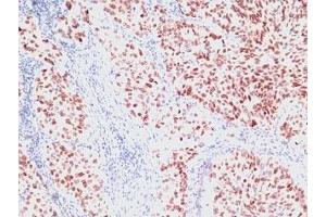 Formalin-fixed, paraffin-embedded human lung carcinoma stained with NKX2. (NKX2-1 Antikörper)