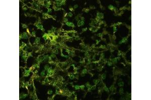IF analysis of ELAVL4 using anti-ELAVL4 antibody (ABIN3043372) ELAVL4 was detected in paraffin-embedded section of human glioma tissues.