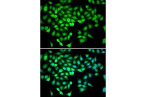 Immunohistochemistry of paraffin-embedded human kidney cancer using DDX21 antibody at dilution of 1:100 (40x lens). (DDX21 Antikörper)